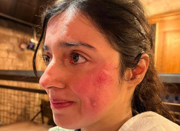 Divya Khosla gets “Badly injured” on sets of her upcoming film; says, “But the show must go on” : Bollywood News